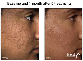 facial acne
