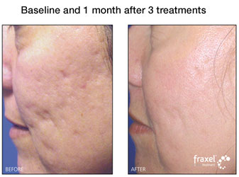 facial acne