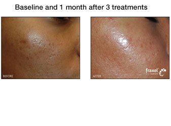 facial acne