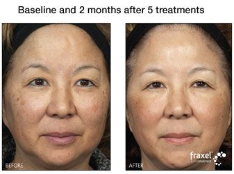 fraxel treatment