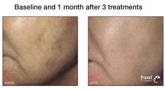 fraxel treatment