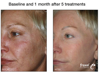 fraxel treatment