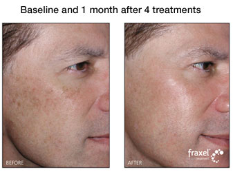 fraxel treatment