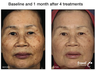 fraxel treatment