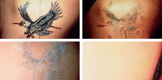 How Can I Get a Tattoo Removed? • Tattoodo