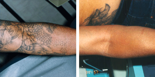 First class tattoo removal service  From 9440  Wakefield MA  Groupon