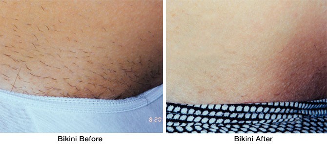 Brazilian Wax Pictures Before And After Female